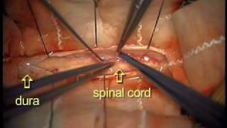 Dr Ali Bydon Performs A Spinal Cord AV Fistula Repair [upl. by Darrej251]