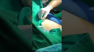 Femoral nerve block  ALR [upl. by Domenic]