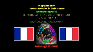 Échocardiographie  Hypokinésie Inférolatérale Et Inférieure [upl. by Conchita]