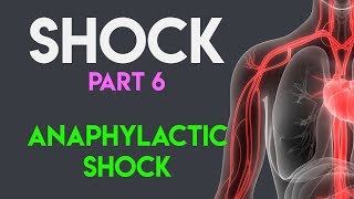 Anaphylactic Shock  Shock Part 6 [upl. by Infeld]