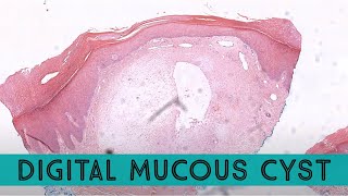 Digital mucous cyst Digital myxoid cyst similar to ganglion cyst pathology dermpath dermatology [upl. by Thrasher]