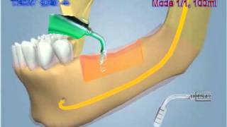 Flapless Alveolar Crest Splitting Surgical Protocol Knochenaufbau Kieferkamm  Verbreiterung [upl. by Swift353]