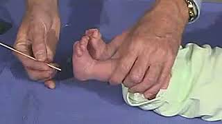 321  Reflexes Plantar Reflex  Newborn Normal  Infant Clinical ExaminationMRCP [upl. by Mahoney772]