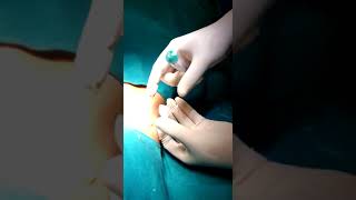 Ilioinguinal nerve block in child for hernia SX [upl. by Ardied]