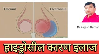 hydrocel kya hai hydrocele treatment हाइड्रोसील कारण लक्षण इलाज [upl. by Ycrem]