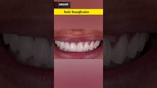 Microdontia  Yellow Stained Teeth  Gummy Smile  Tilted Incisor Treatment shorts dentist viral [upl. by Nyleuqaj]