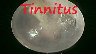 Pulsatile Ear Drum  Abnormal Finding on Otoendoscopy in Patient with Tinnitus [upl. by Catherina]