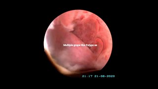 Hysteroscopic Polypectomy for Multiple Polyps I Dr Rajeev Agarwal [upl. by Calise]