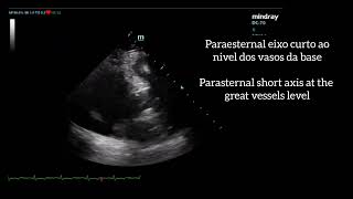 Mechanical Valve Prosthesis and mitral annuloplasty [upl. by Atiugram]