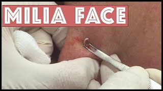 Milia Extractions on the face [upl. by Yelsew]