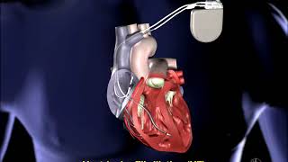 Defibrillation Therapy [upl. by Immanuel]