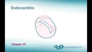 INFECTIVE ENDOCARDITIS ECHOCARDIOGRAPHY  BASICS OF IE Transthoracic vs Transoephophageal Echo [upl. by Notgnilra]