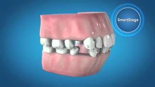 Invisalign G6 Innovations for First Premolar Extraction [upl. by Peterus]