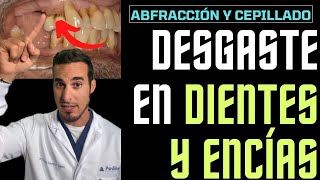 DESGASTE en DIENTES y ENCÍAS  Esto te podría estar pasando [upl. by Royce]