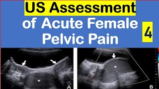 US assessment of acute female pelvic pain part 4 [upl. by Maffei]