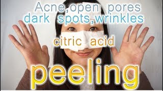 Acne Dark Spots  हिंदी  How to treat  serum cream recommendations  Dermatologist  Dr Aanchal [upl. by Hatokad611]