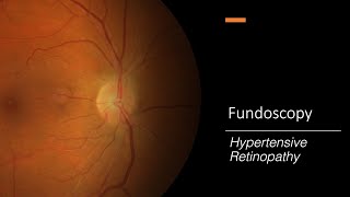 Hypertensive Retinopathy Fundoscopy [upl. by Erodasi227]