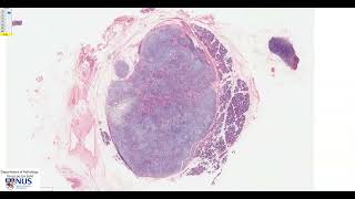 Salivary gland Pleomorphic adenoma Microscopy  Talking slide [upl. by Amalberga]