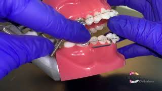 Repairing a Forsus Spring  Dougherty Orthodontics St Louis Missouri [upl. by Enrobialc]