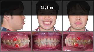 First Premolar Extraction Treatment with Clear Aligners｜【Chris Chang Ortho】CC568 [upl. by Callan]