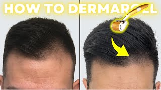 How to Derma Roll for Quickest Hair Results StepbyStep Guide [upl. by Enoob39]