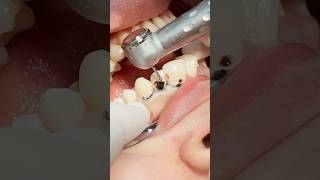 Deep caries fiber post and composite restoration dentist [upl. by Noiram]