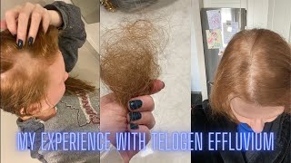 My Experience with Telogen Effluvium [upl. by Ileyan]