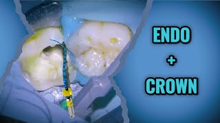 84 Massive cavity leads to root canal and crown live procedure [upl. by Niliac]