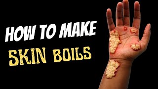 How to Make Skin Boils [upl. by Nadbus]