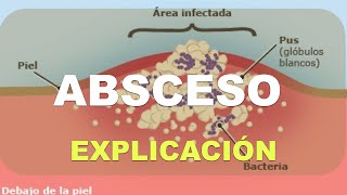 Qué es un absceso y cómo se forma [upl. by Annoek]