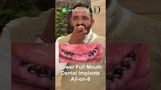 Full Mouth Dental implants All on 8 immediate permanent teeth fixed jalandhar punjab dentist [upl. by Uttica]