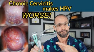 HPV combined with chronic cervicitis increases the risk of severe dysplasia and cervical cancer [upl. by Sukramal]