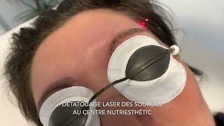 Détatouage laser des sourcils [upl. by Ennaed]