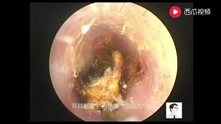 Earwax Removal Extraction Cholesteatoma of the middle ear canal exfoliate of tympanic membrane [upl. by Yllim]