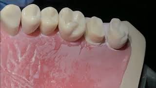 PFM occlusal reduction ADC exam [upl. by Jen]