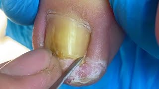 Huge Ingrown Nail Removed From Very Thick and Hard Toenail Fungus 【Yinuo Pedicure】 [upl. by Derfliw]