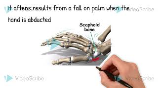 fracture of scaphoid bone [upl. by Adnirem]