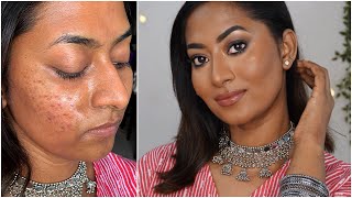 Dark skin makeup tutorial ✨ how to cover hyperpigmentation amp acne scars [upl. by Oeniri768]