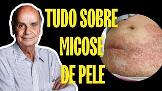 MICOSE DE PELE  TUDO QUE VOCÊ PRECISA SABER SOBRE ESSA DOENÇA VEJA O VÍDEO [upl. by Bbor]