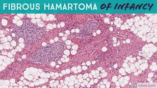 Fibrous Hamartoma of Infancy [upl. by Nahtnahoj]