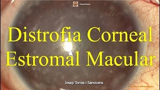 Distrofia Corneal Estromal Macular [upl. by Anirec]