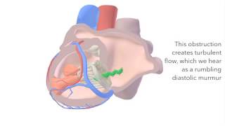 Mitral Stenosis  sound amp animation [upl. by Cairistiona644]