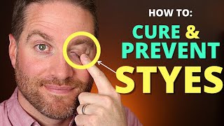 How To CURE And PREVENT STYES Get Rid Of A Hordeolum stye And Chalazion Fast [upl. by Avle66]