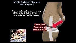 Medial Collateral Ligament Injuries  Everything You Need To Know  Dr Nabil Ebraheim [upl. by Repsihw]