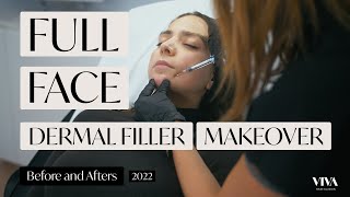 FULL FACE Dermal Filler Makeover  Before amp Afters  VIVA Skin Clinics 2022 [upl. by Caldwell621]