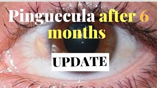 How I fight pinguecula yellow spot on eyes after 6 months updateNO MORE RADISH JUICE [upl. by Aicilet590]