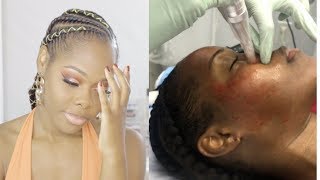 Microneedling Before and After on Dark Skin  GRWM [upl. by Azarria]