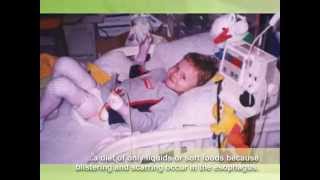 Epidermolysis Bullosa EB Awareness video extended [upl. by Reteid]