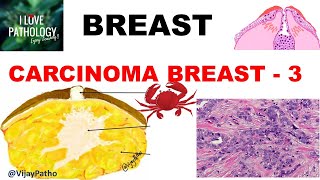 Diseases of Breast Part 6 Breast carcinoma InvasiveTypes MorphologyPrognosis amp treatment [upl. by Assilim]