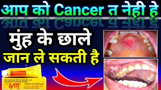 Zytee Rb Gel uses In Hindi  Zytee rb gel  मुंह के चाले की बेस्ट जेल  Doses  Uses  Sideeffect [upl. by Knarf]